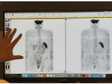 冠動脈が石灰化。それでも僕の心臓は今日も元気に動いてる