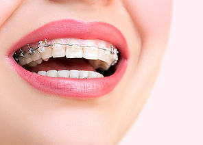 Close up open mouth with Ceramic and Met