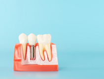 初めてインプラント治療を受ける方必見！インプラントの魅力、クリニック選びのポイント、ケア方法とQ&A