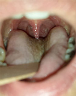 Catarrh treatment at Mike Dilkes ENT Lazer Surgery