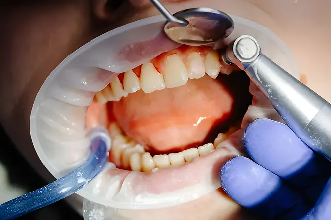 Preventive Dentistry (1).webp
