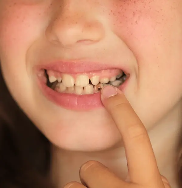 What Are Pulpotomy & Pulpectomy (2).webp