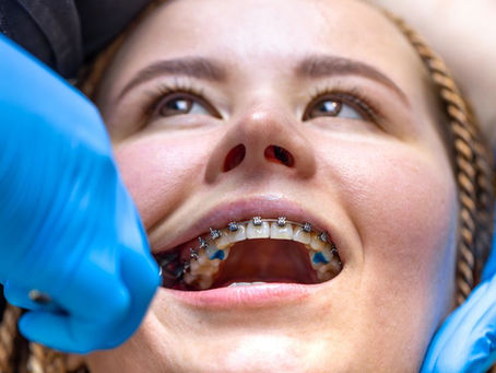 Clear Braces