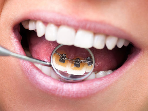 Lingual Braces