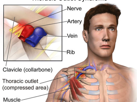 Understanding Thoracic Outlet Syndrome: Causes, Symptoms, and Solutions