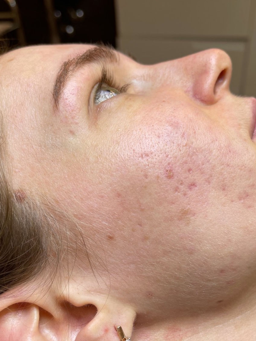 Žena s pihami a akné leží. Profil obličeje, detailní pohled, My Site 2.