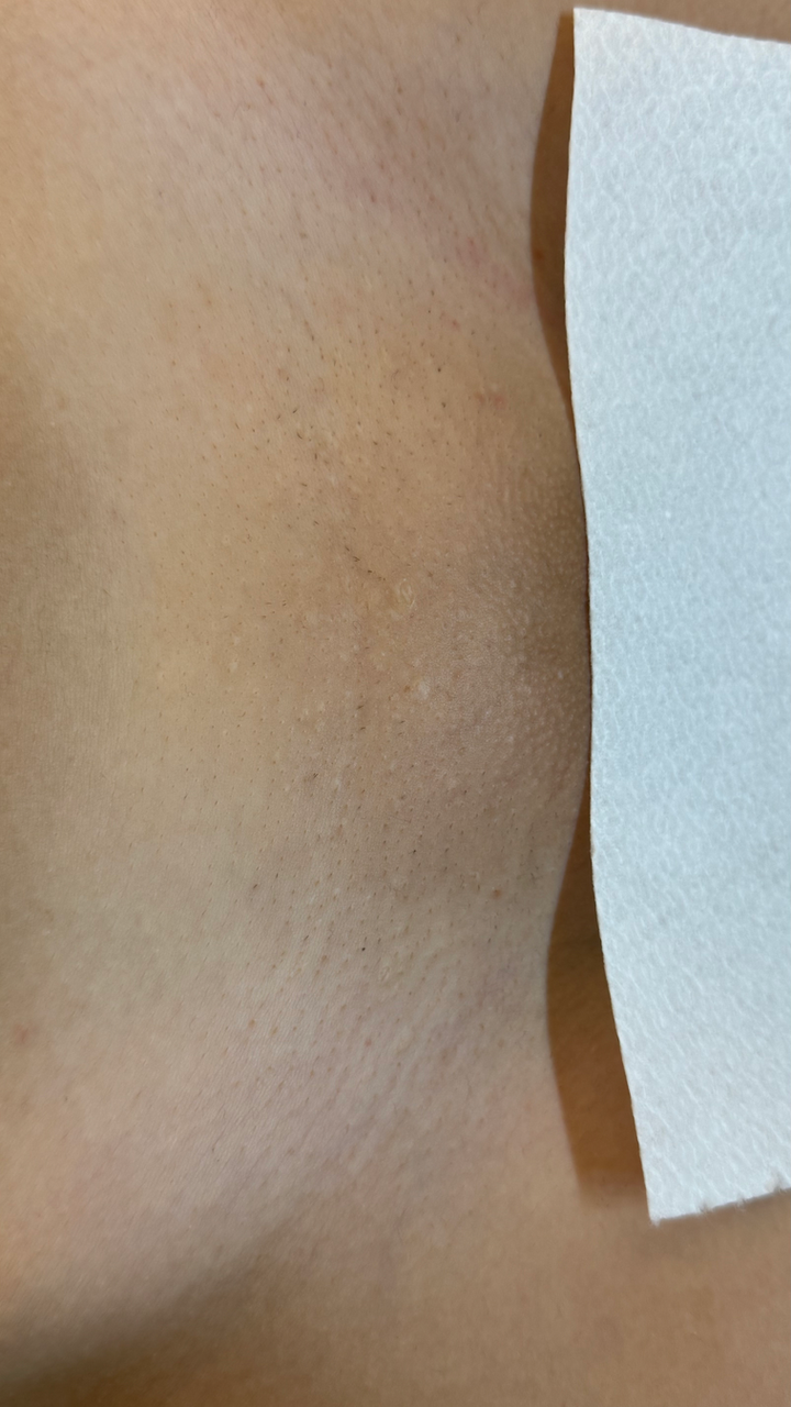 Depilace voskem na kůži se provádí pro odstranění chloupků na těle.