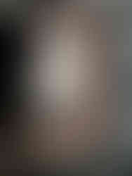 right patch with bonds