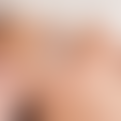 Lifting acupunctural : un traitement royal ancestral