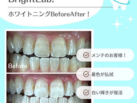 【歯の本来の白さへ…✨】