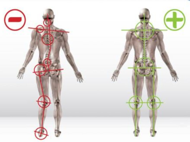Esquema de un cuerpo visto por detrás: a la izquierda, con desalineación marcada en rojo; a la derecha, alineado y marcado en verde