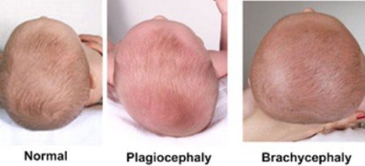 Comparación de tres cráneos de bebé vistos desde arriba: normal, con plagiocefalia y con braquicefalia