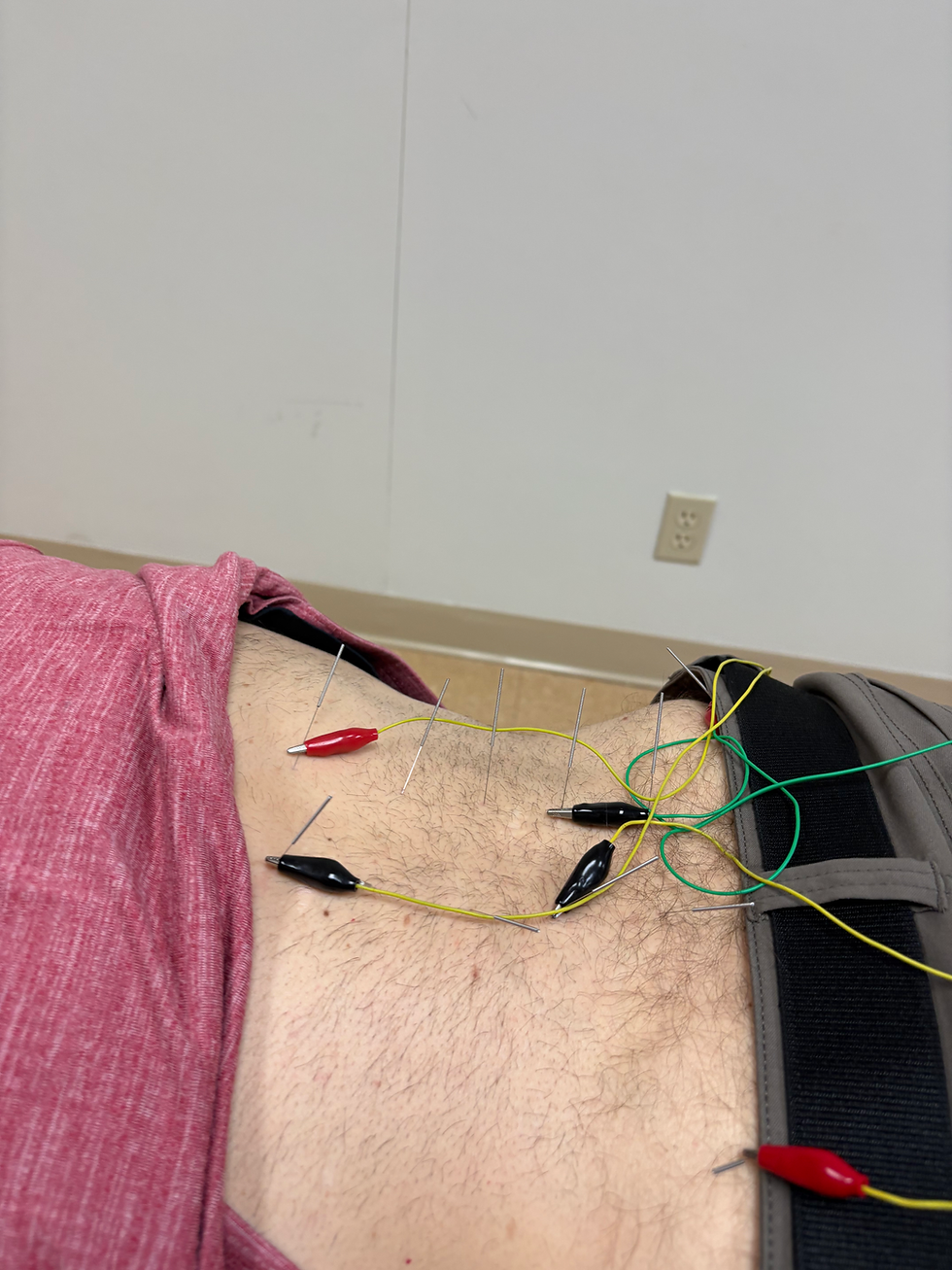 Electroacupuncture of the lower back for sciatica and low back pain