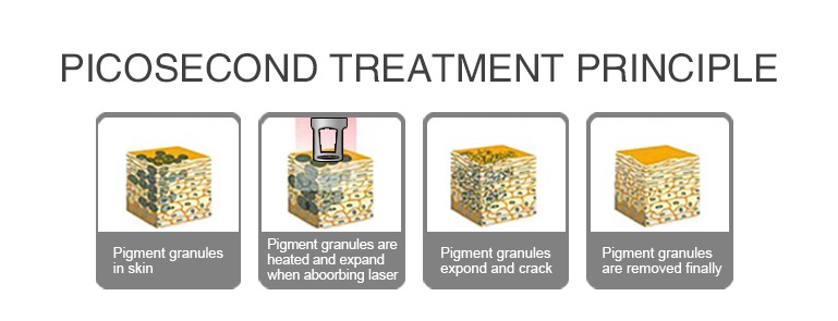 Thumbnail: 2000MJ Picosecond Laser Machine for Chloasma Removal and Age Spots Removal