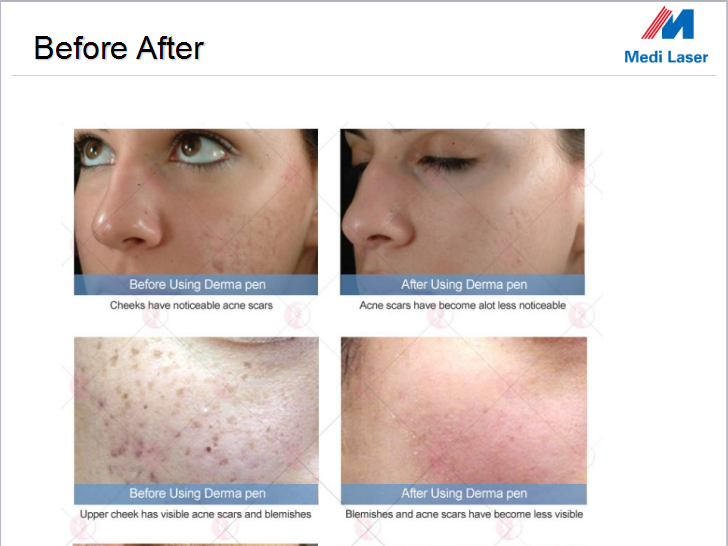 Thumbnail: New Powerful Wireless E30 Dr. Pen Microneedle Derma Pen