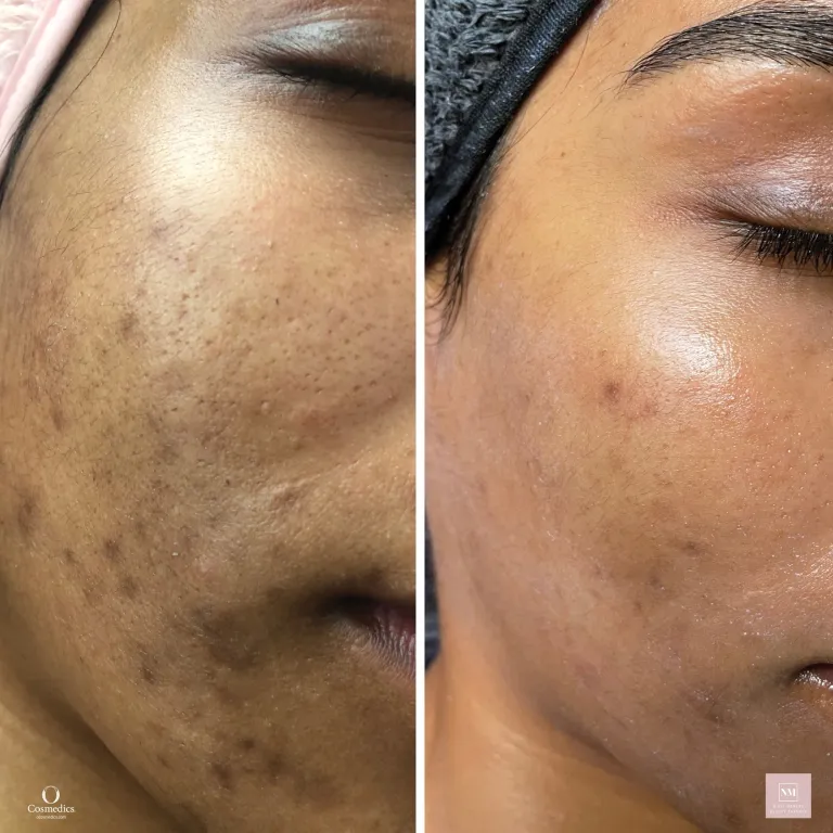 OCosmedics Dermal Treatment Before and After Photo