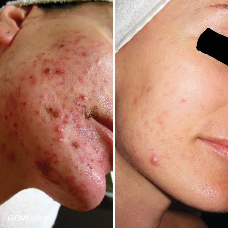 DMK Skin Revision Before and After Photo