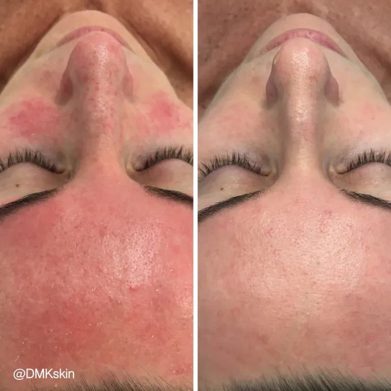DMK Skin Revision Before and After Photo