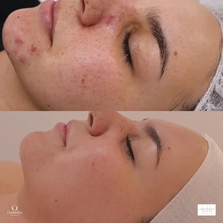 OCosmedics Dermal Treatment Before and After Photo