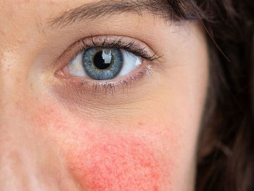Redness on the face: From reddened skin to rosacea