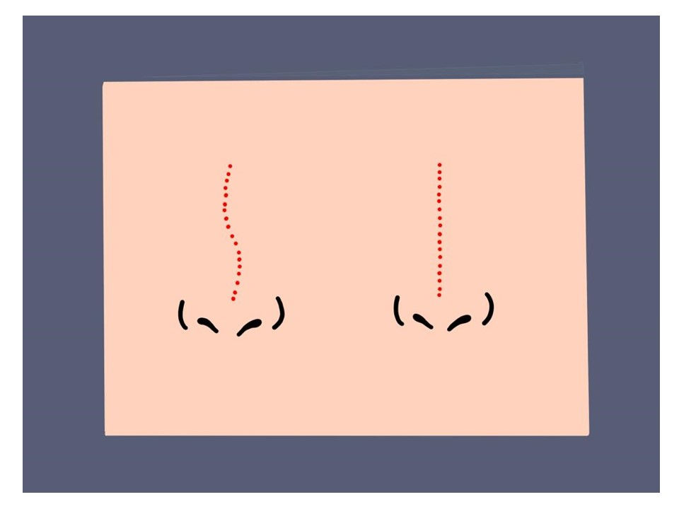 septum deviasyonu.jpg