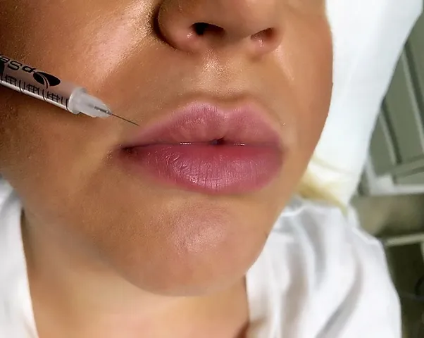 Dolgu Maddesi Enjeksi Yonu Ile Guzelli K Doc Dr Berna Aksoy