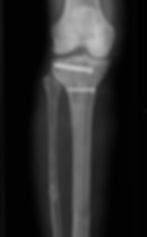 Tibia Nail