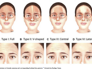 Botox Isn’t One-Size-Fits-All
