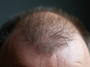 Understanding Common Causes of Hair Loss and Effective Prevention Strategies