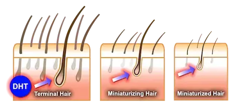 Diagram depicting hair miniaturization stages: Terminal Hair, Miniaturizing Hair, and Miniaturized Hair, with arrows and DHT labeled.