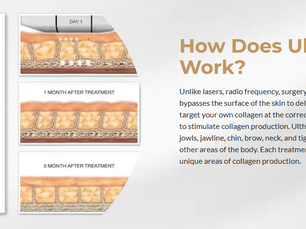 Discover the Juanderful "Lunchtime Lift": Everything You Need to Know About Ultherapy