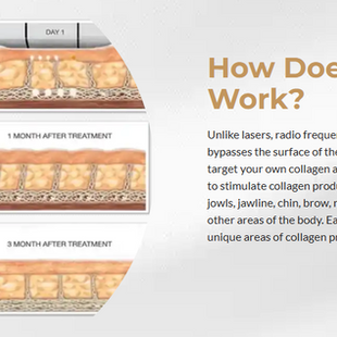 Discover the Juanderful "Lunchtime Lift": Everything You Need to Know About Ultherapy