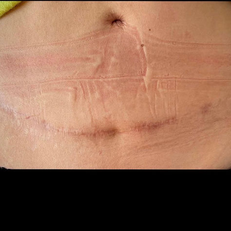 Une séance que je n'oublierai jamais - Recouvrement de cicatrice avec un tatouage - Lausanne.