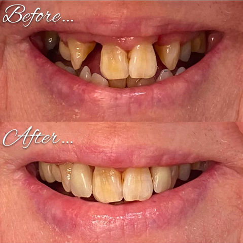 Side-by-side images depicting the results of a dental implant
