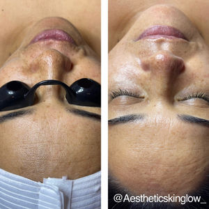 Brightening Facial