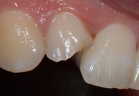 facette dentaire cabinet dentaire d'occ