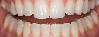 Home teeth whitening after photo