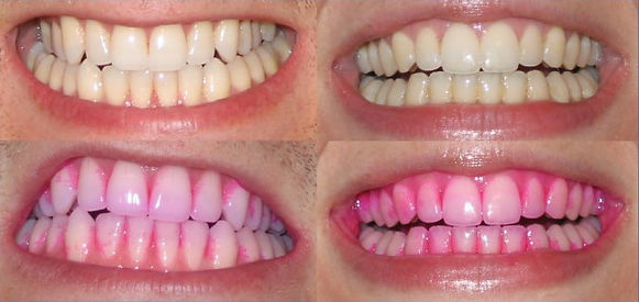 How to use Opalescnce GO Teeth Whitening System