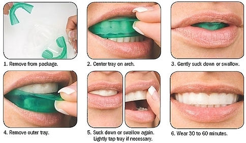 How to use Opalescnce GO Teeth Whitening System