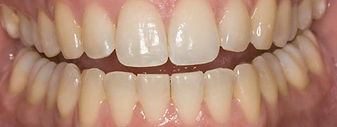 Home teeth whitening before photo