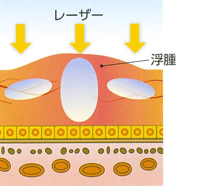 網膜光凝固術イラスト説明画像