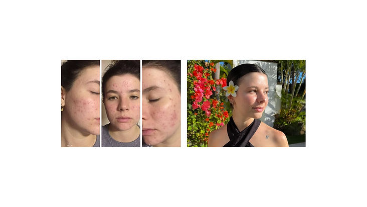 Transforma Tu Piel Guía para Vencer el Acné Hormonal.jpg