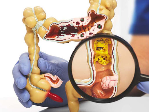 Colorectal Cancer: A Silent Threat in the Latino Community—Why Early Screening Saves Lives
