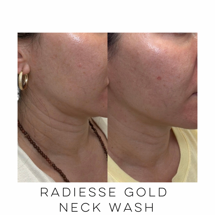 Opposite profile before and after showing improved neck skin quality following Radiesse Gold Neck Wash treatment at Skin Treats Aesthetics in Louisville, KY.