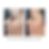 RF microneedling patient results for smoother skin texture and acne scars in Louisville KY