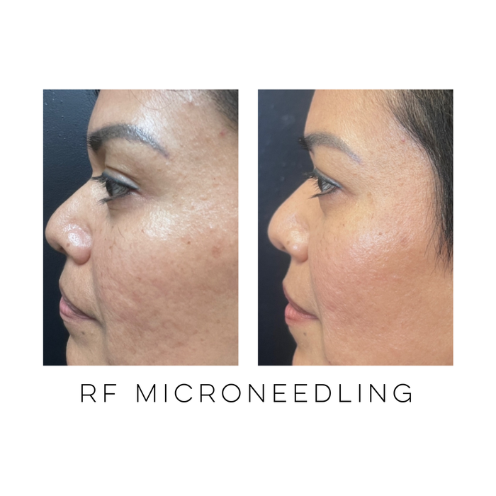 Profile view of a patient before and after RF microneedling treatment demonstrating smoother skin texture, improved pore appearance, and healthier-looking skin at Skin Treats Aesthetics in Louisville, KY.