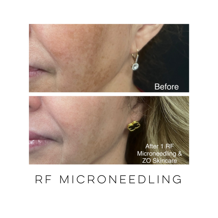 Close-up view of a patient before and after one RF microneedling treatment showing improved skin texture, tone, and overall skin quality at Skin Treats Aesthetics in Louisville, KY.
