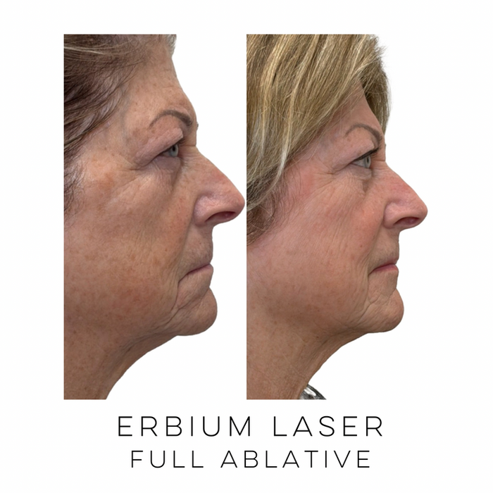 Side profile of a patient before and after full ablative Erbium laser treatment showing smoother skin texture and natural-looking skin rejuvenation at Skin Treats Aesthetics in Louisville, KY.