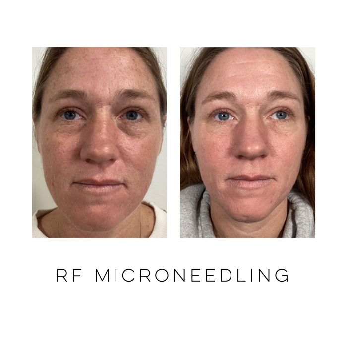 Front view of a patient before and after RF microneedling treatment showing improved skin tone, smoother texture, and healthier-looking skin at Skin Treats Aesthetics in Louisville, KY.