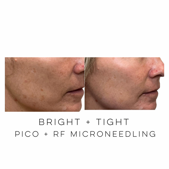 Profile view of a patient before and after RF microneedling combined with Erbium laser resurfacing showing improved skin texture, firmer-looking skin, and overall skin quality at Skin Treats Aesthetics in Louisville, KY.